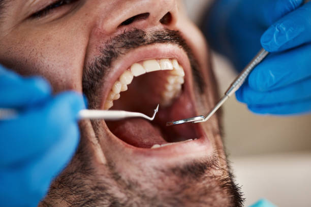 Best Knocked-Out Tooth (Avulsed Tooth) Treatment in Trinity, NC